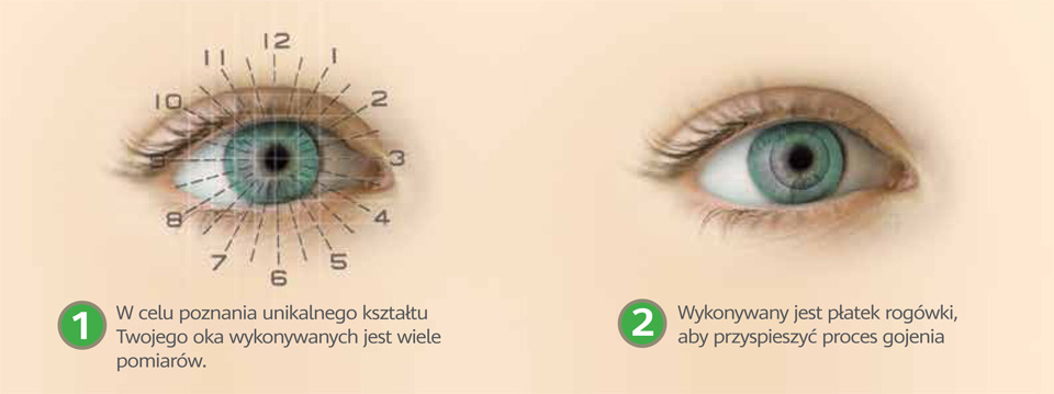 laserowa korekcja wad wzroku mapa oka